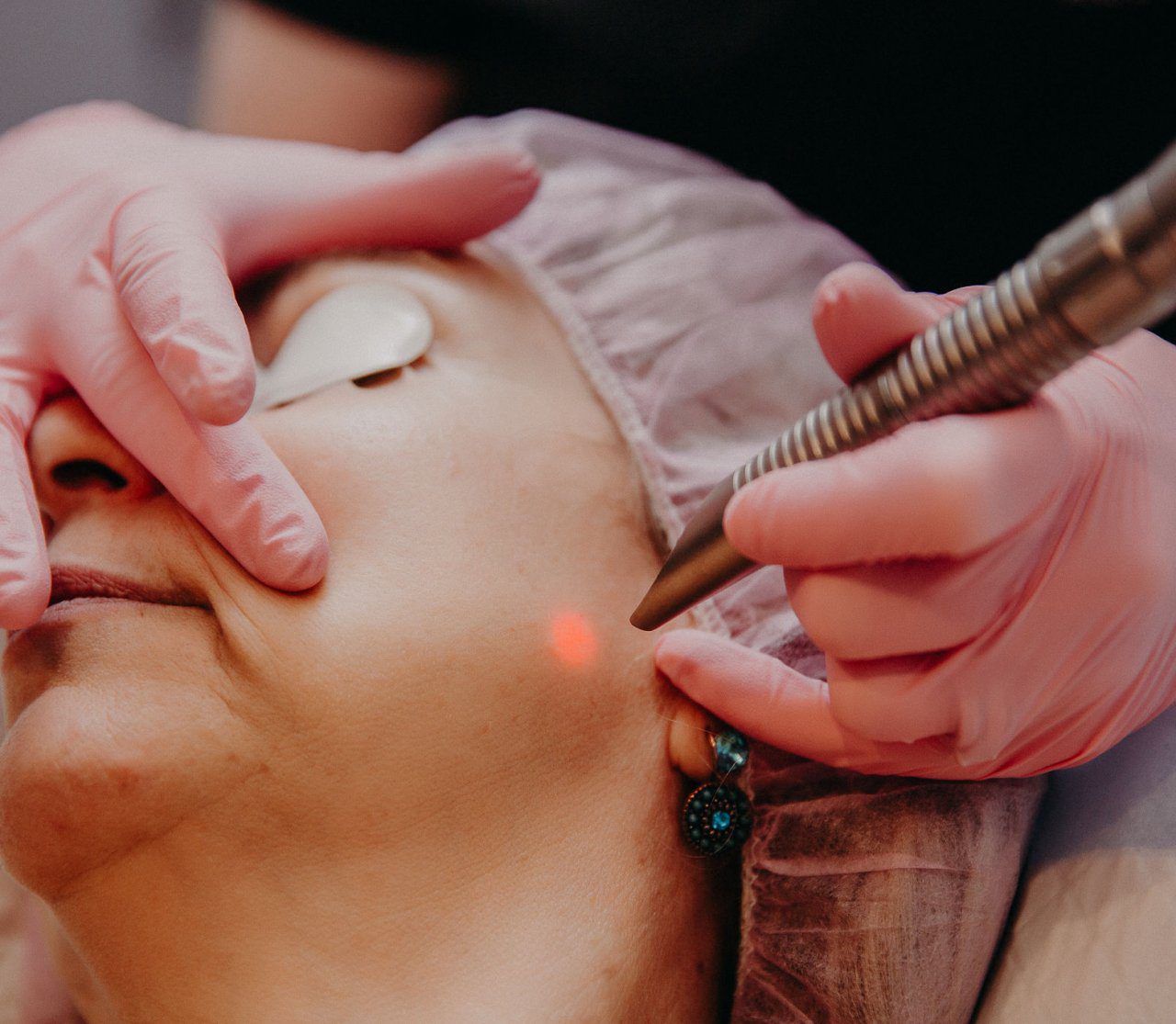 New You client receives laser treatment on her face