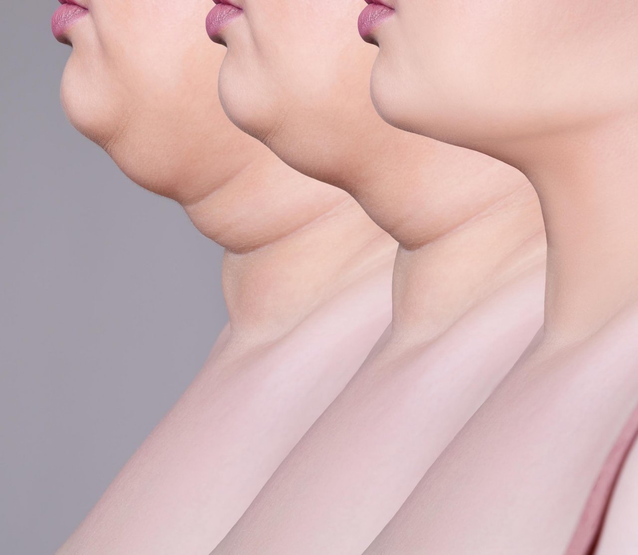 A woman with fat around her chin, as the fat disappears over time