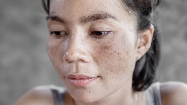 Hyperpigmentation: Types, Causes and Treatments Image