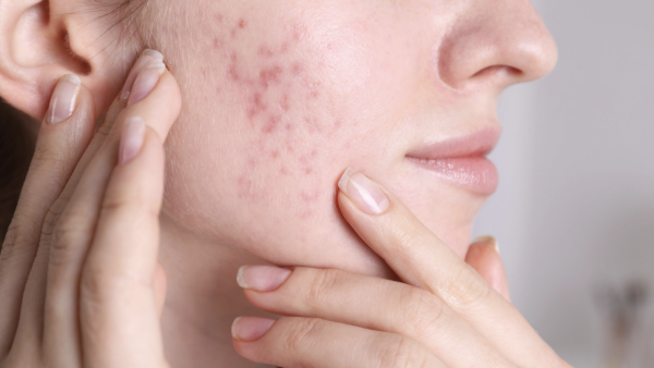 The Truth About Rosacea and why it is so hard to treat Image